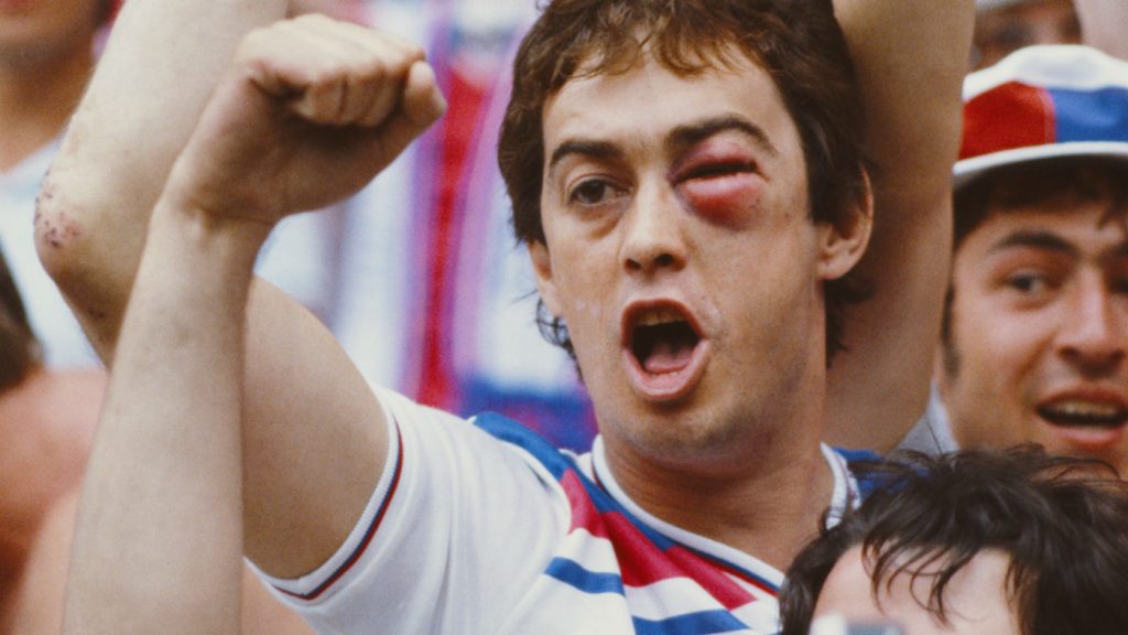photo of a football supporter with a very swollen black eye
